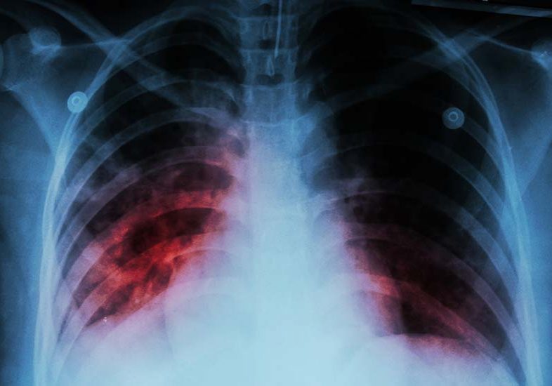 chestXray